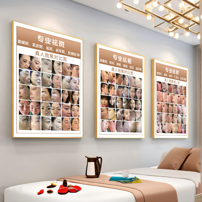 美容院祛斑海报前后对比图皮肤病挂画斑痘敏宣传画祛斑祛痘广告图